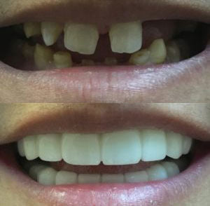 Snap On Smile (BG) 4