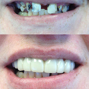 Snap On Smile (BG) 2