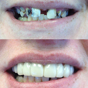 Snap On Smile (GR) 2