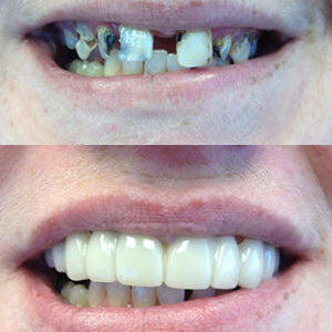 Snap On Smile (SK) 2