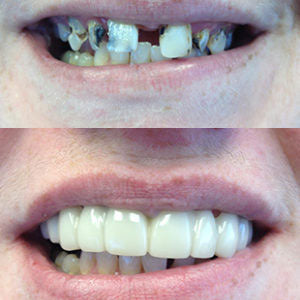 Snap On Smile (CY) 2