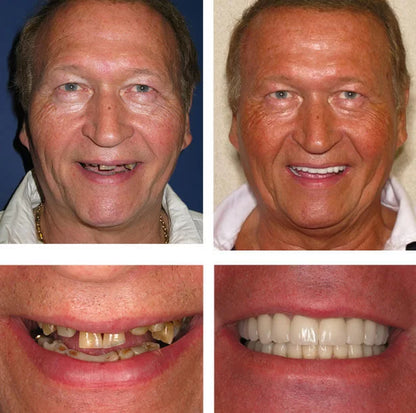 Snap On Smile (PL) 1