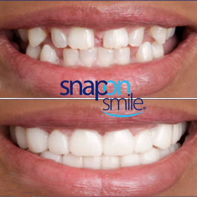 Snap On Smile (SK) 5