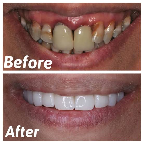 Snap On Smile (SK) 7