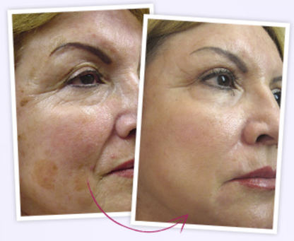 Elesse Cream crema anti-riduri cearcane pete