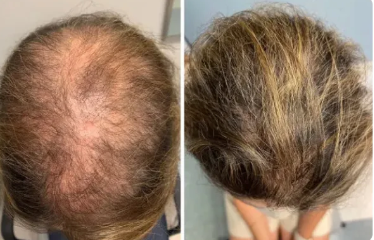 Lossless Shampoo (RS) 3