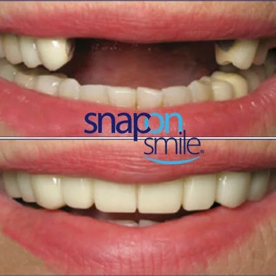 Snap On Smile (SK) 1