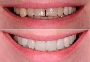 Snap On Smile (GR) 9